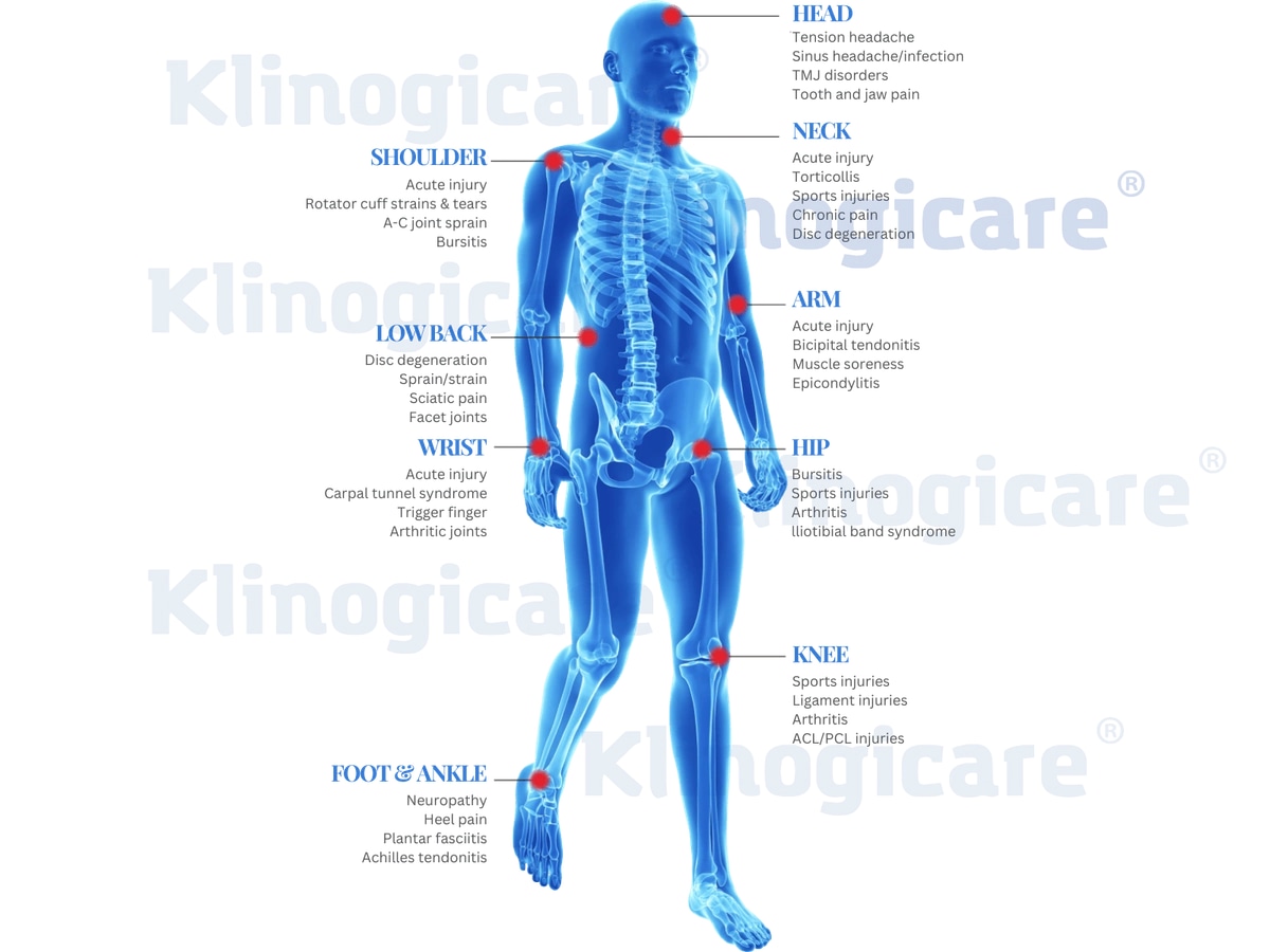 Анатомический атлас Klinogicare: зоны применения HILT — голова, шея, плечо, рука, поясница, запястье, таз, колено, стопа и голеностоп